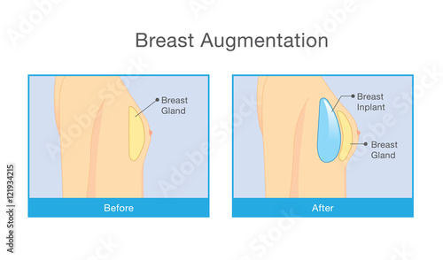 Woman body before and after breast augmentation. Illustration about cosmetic surgery.