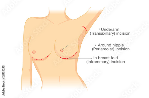 Incision points in breast implant surgery. Illustration about cosmetic surgery.