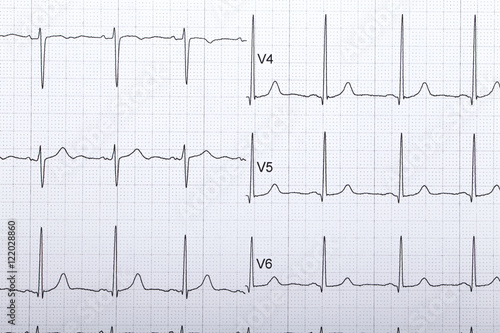 electrocardiogram
