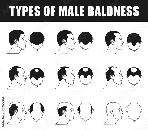 male baldness, type baldness, head baldness, norwood scale, human baldness, alopecia progress, age baldness, type of male baldness