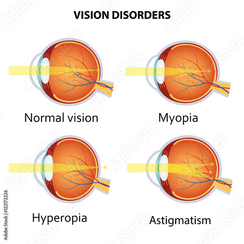 Common vision disorders. photo