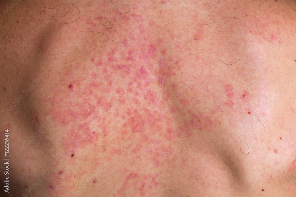 Skin fungus on his back. Red spots on the backs of men. Mold. Skin fungus on his back. Red spots on the backs of men. Mold.