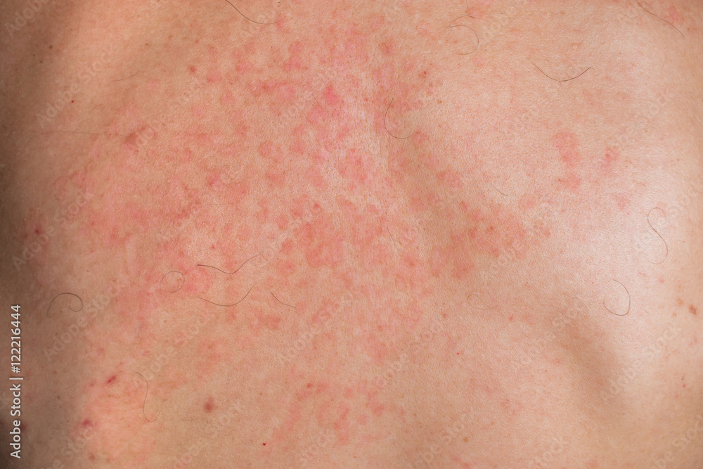 Skin fungus on his back. Red spots on the backs of men. Mold.
