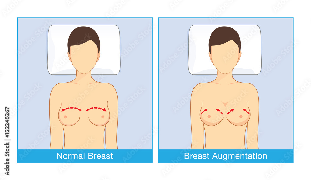 Vetor de Normal breast shape and breast implant shapes of woman when lying  with turning face up. Illustration about cosmetic surgery. do Stock