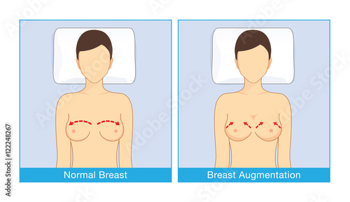 Normal breast shape and breast implant shapes of woman when lying with turning face up. Illustration about cosmetic surgery.