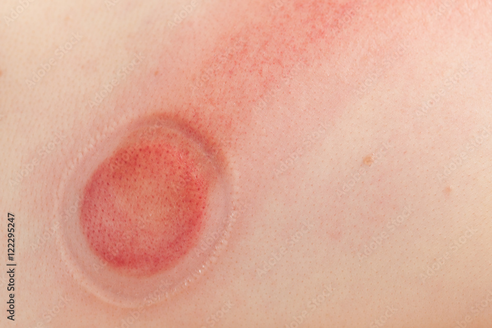 Fototapeta premium Human back, receiving vacuum cupping massage