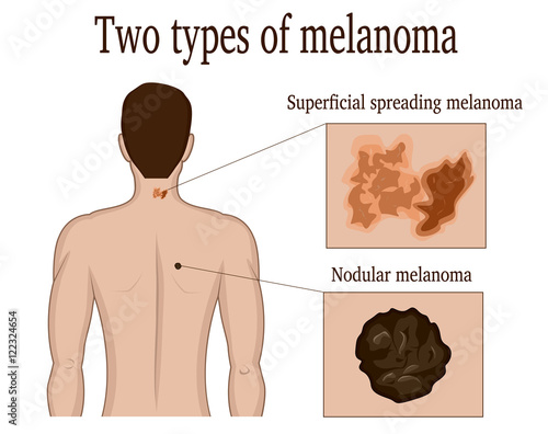 Two types of skin melanoma on the neck and back of a man