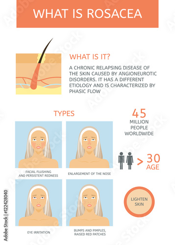 Rosacea: Causes, Types and facts. Infographics