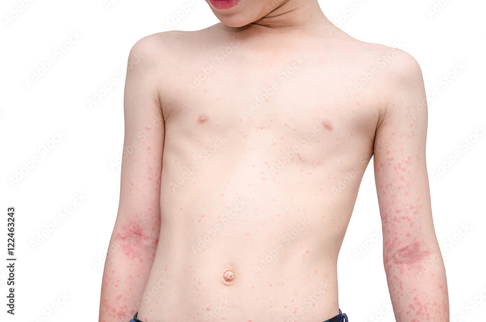 Young asian child skin with rash over white background.