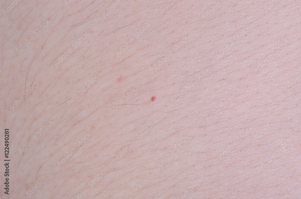 Fototapeta premium Small magenta dot's on the skin.