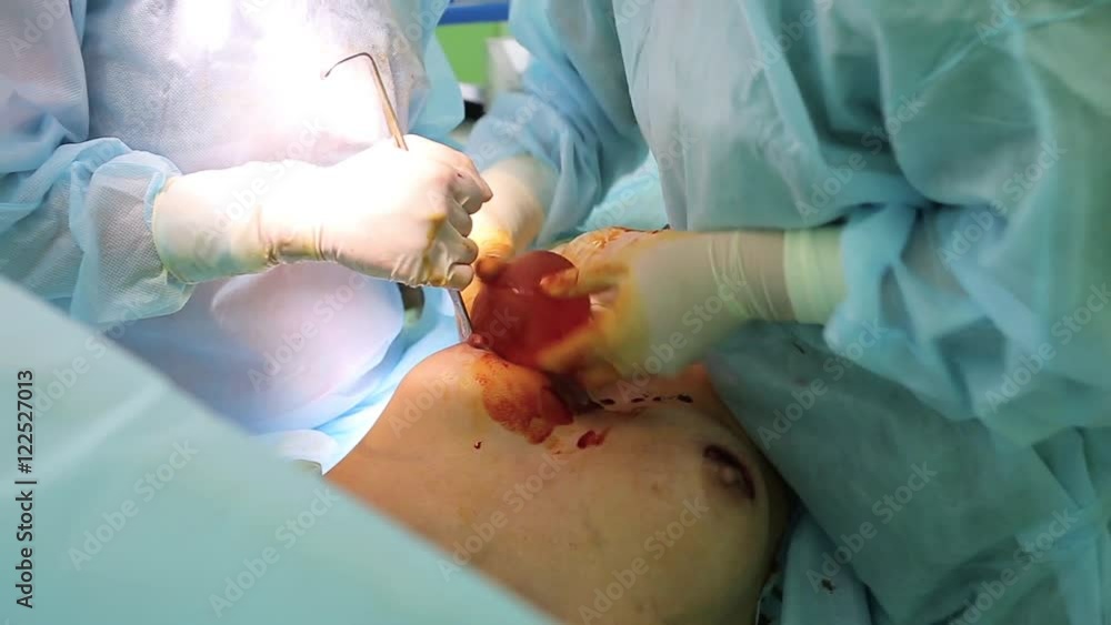 Insert the implant in the breast Insert the implant in the breast