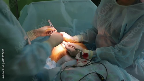 Insert the implant in the breast