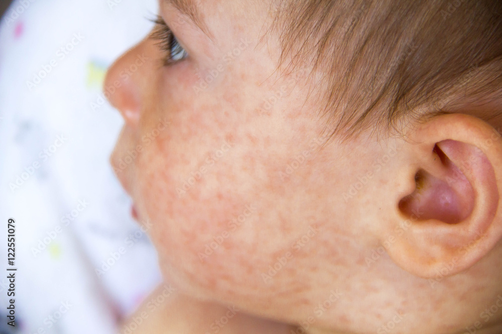 Baby Allergy Rash Baby allergy rash
