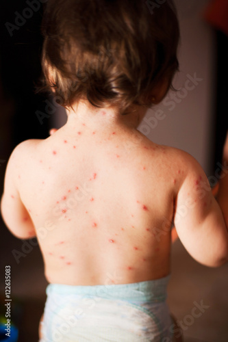 Fotografie Little girl with chicken pox rash