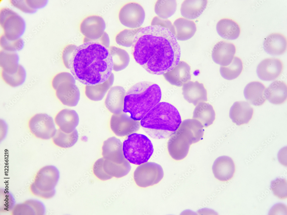 Fototapeta premium Leukemia cells in peripheral blood smear, Wright stain