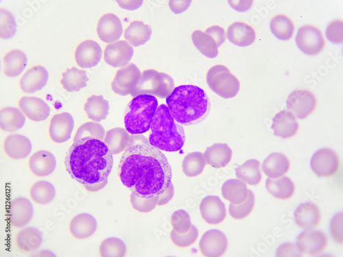 Obraz na płótnie Leukemia cells in peripheral blood smear, Wright stain 