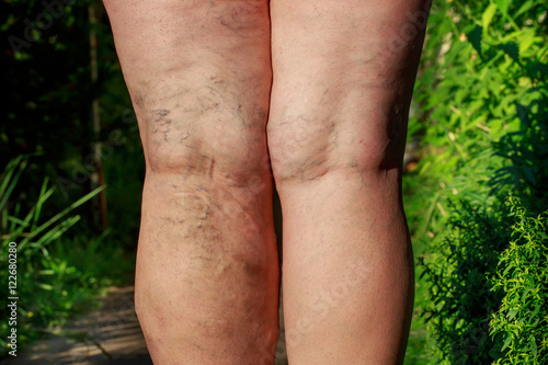 Fotografie the phlebeurysm on legs