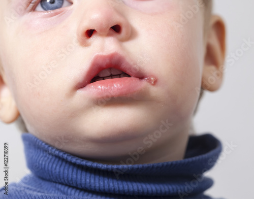 herpes on the mouth of the child photo