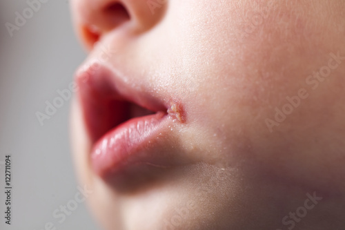 herpes on the mouth of the child
