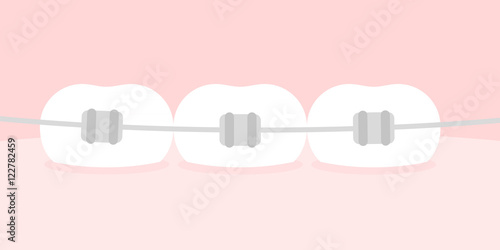 Teeth braces. Flat illustration