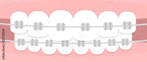 Teeth braces. Flat illustration