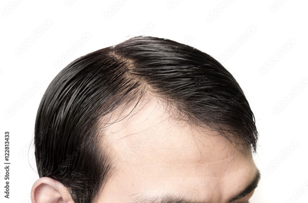 Closeup young man serious hair loss problem for hair loss concept Closeup young man serious hair loss problem for hair loss concept