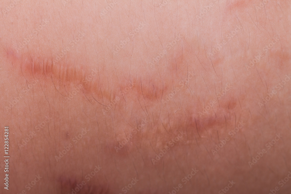 Closeup on stretch marks or cellulite on waist belly Closeup on stretch marks or cellulite on waist belly