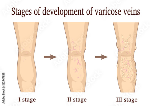 Three stages of the development of varicose veins isolated on white background