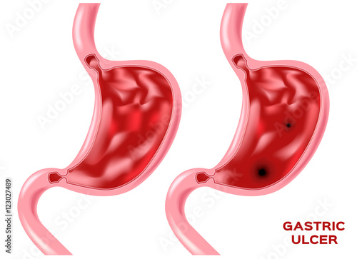 Peptic ulcer disease (PUD). vector illustration of diagram of human stomach anatomy