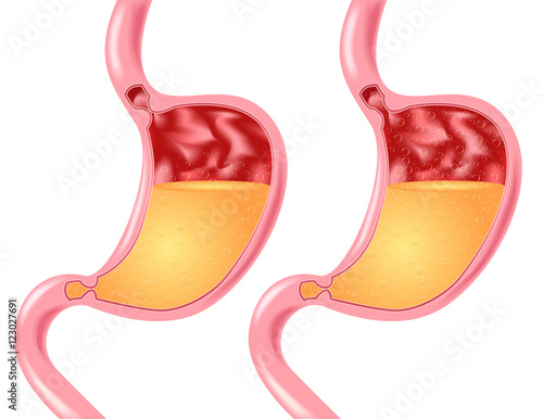 Stomach disease: belching, Heartburn or reflux. stomach vector Human anatomy