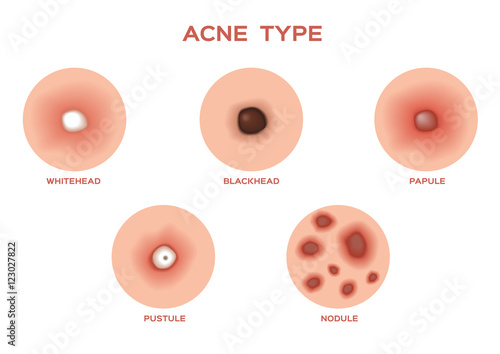 Types of Acne and Pimples, stages of development, vector illustration