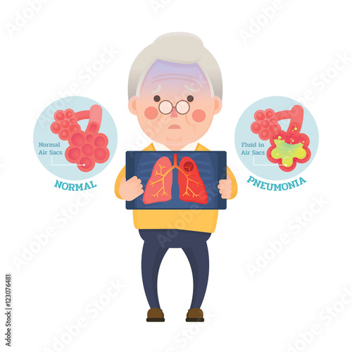 Vector Illustration of Old Man Holding X-ray Image Showing Lung Pneumonia Problem, Cartoon Character
