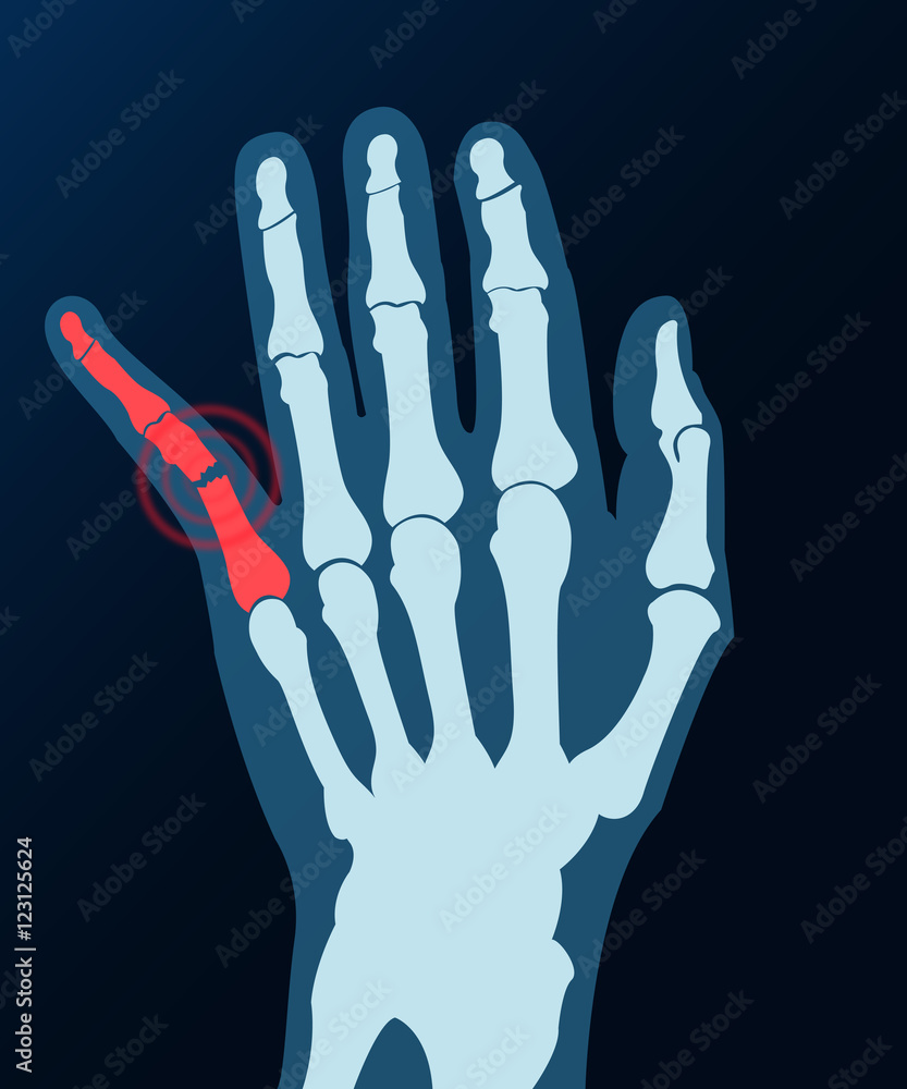 Röntgenbild kleiner Finger gebrochen Grafik Stock Vector Adobe Stock