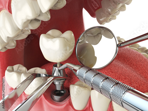 Fototapeta Naklejka Na Ścianę i Meble -  Tooth human implant. Dental implantation concept. Human teeth or