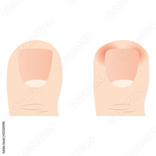 ingrown nail