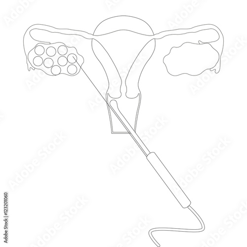 In vitro fertilization, egg pick up (aspiration), puncture of follicles. In black and white, isolated.