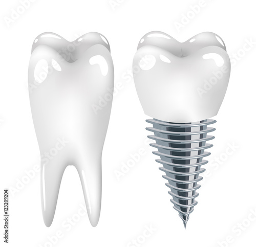 Dental implant dentistry
