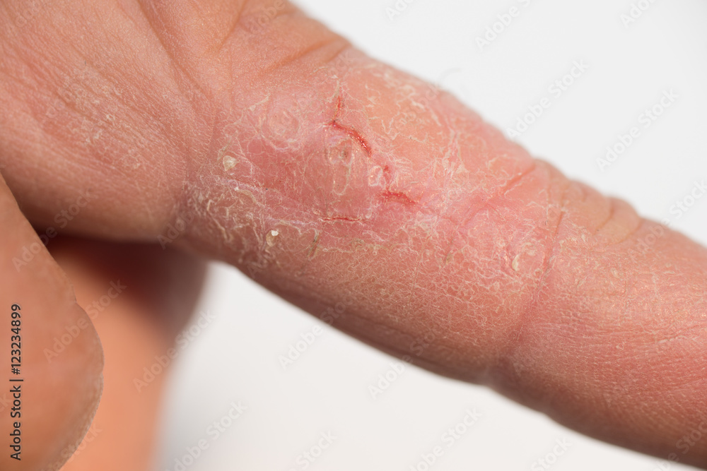 Fissur Mittelfinger links bei extrem trockener Haut im Herbst Fissur Mittelfinger links bei extrem trockener Haut im Herbst