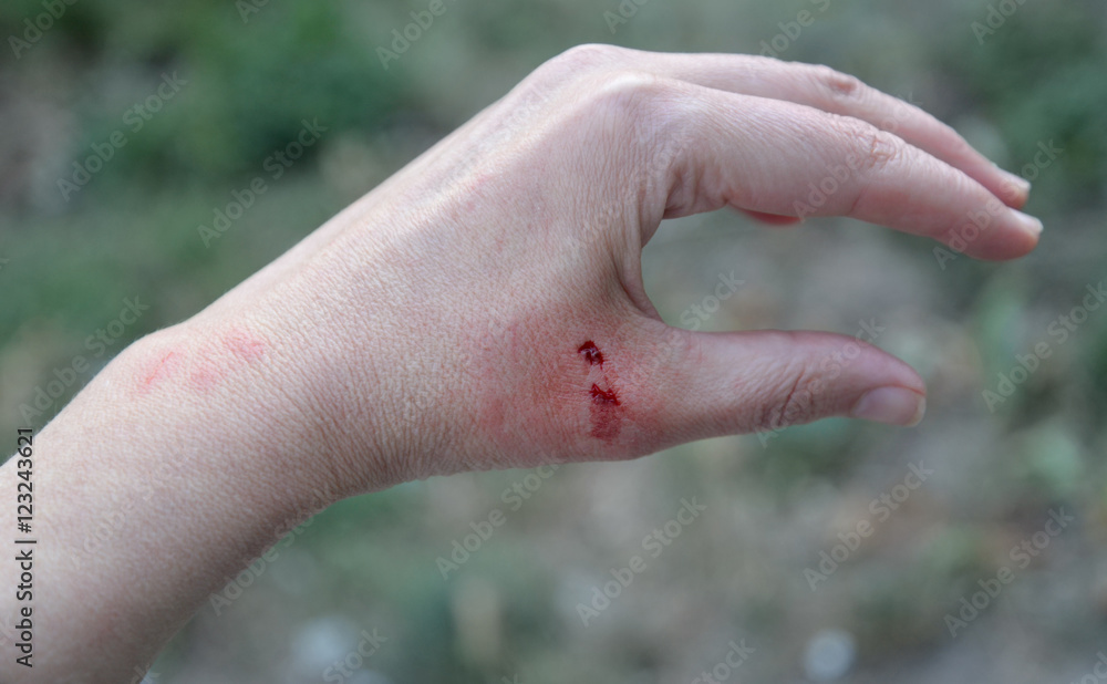 Monkey bite on the hand. Paired wounds from the animal’s upper fangs