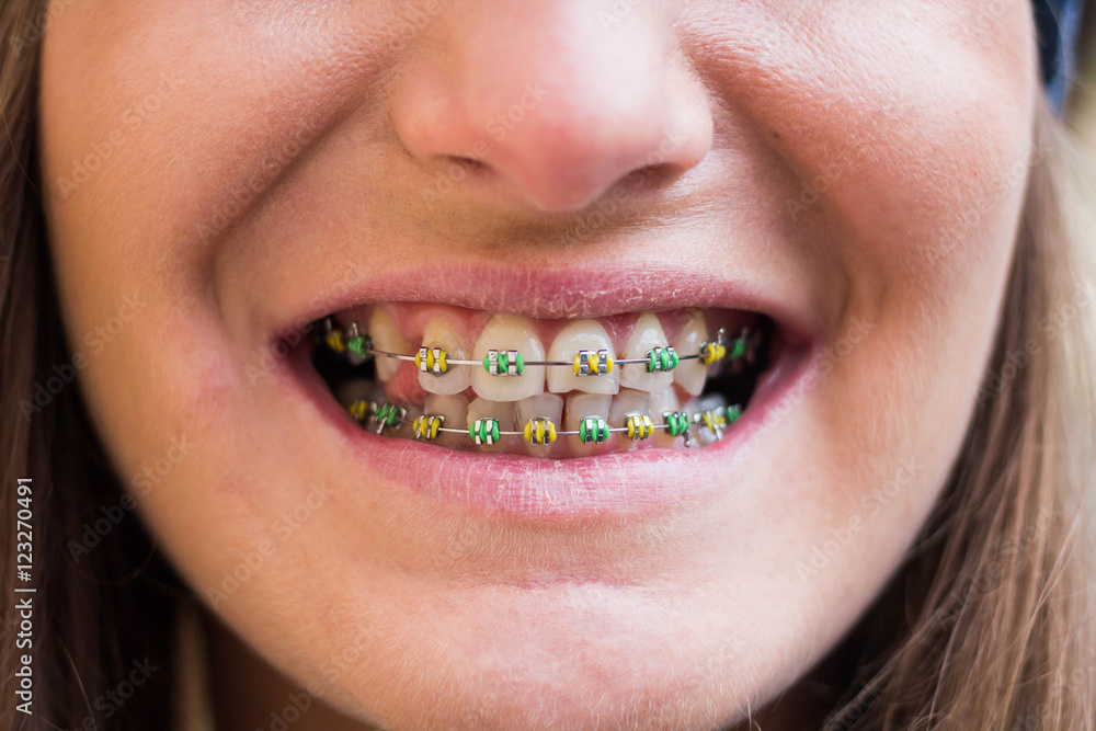 Obraz premium Braces