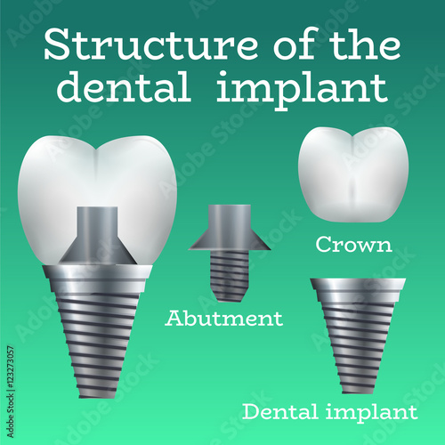 Dental implant structure