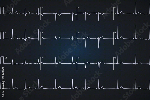 Typical human electrocardiogram, white graph on dark blue background