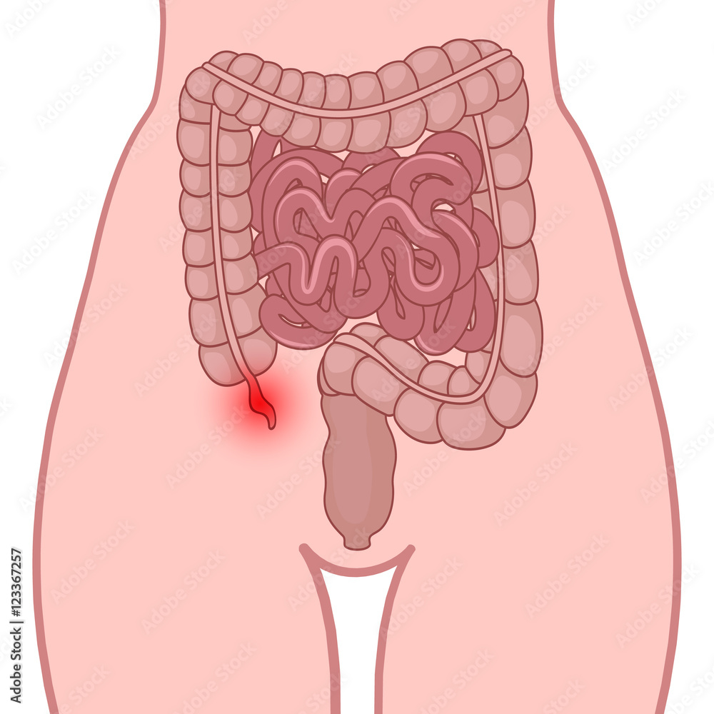 inflammation of the appendix inflammation of the appendix