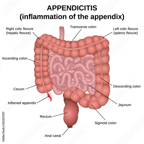 inflammation of the appendix photo
