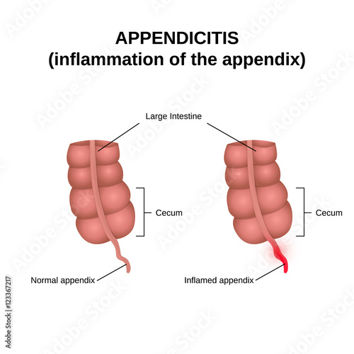 inflammation of the appendix