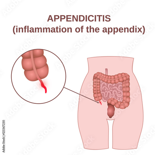 inflammation of the appendix