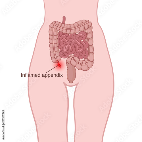 inflammation of the appendix