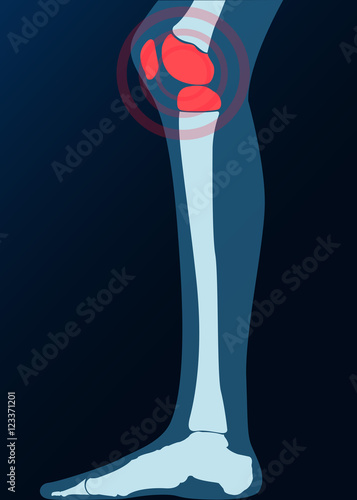 Kniegelenk Probleme Schmerzen Röntgenbild Grafik
