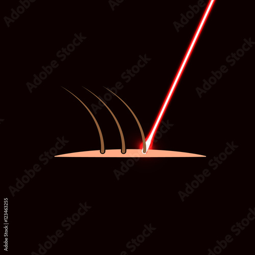 laser hair removal