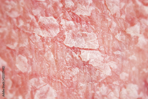 Psoriasis, psoriatic skin disease is red, itchy, and scaly, macro with narrow focus photo
